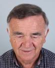 After Hair Transplant&nbsp;Front